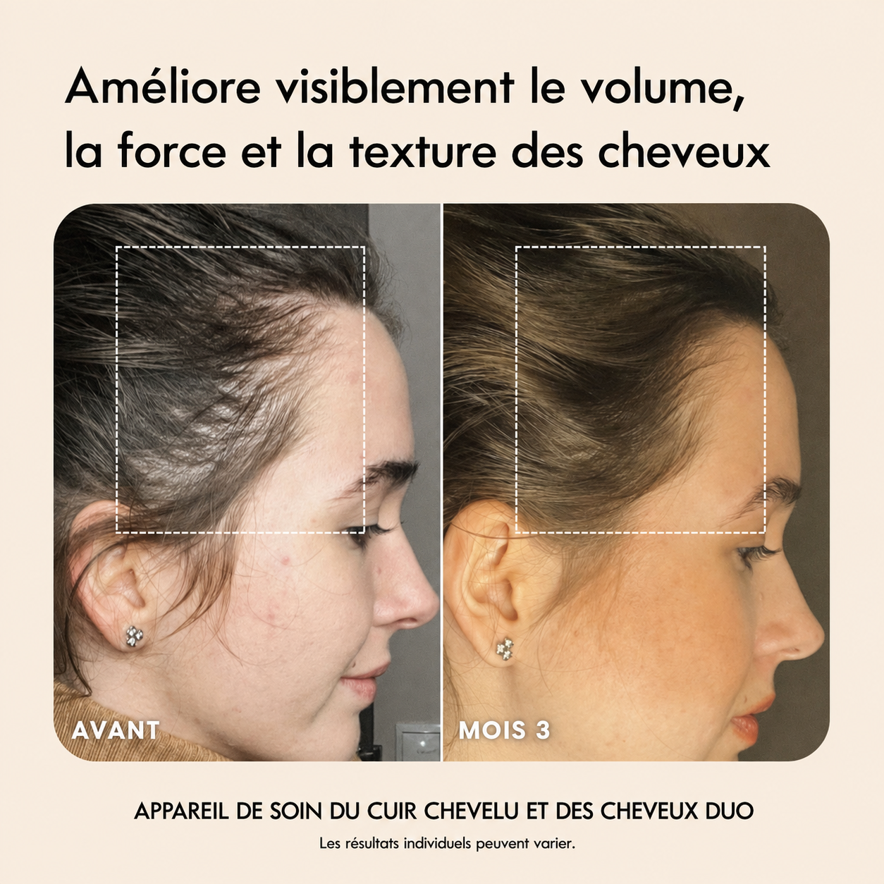 Mirant ScalpCare™ — Brosse LED 4-en-1 pour des cheveux visiblement plus forts + 2 sérums inclus