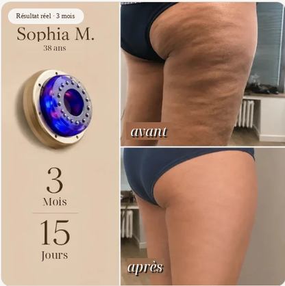 Professional Anti-Cellulite Massager – Vacuum & Infrared Heat Massage | MirantBeauty